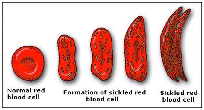 History - Sickle Cell Anemia